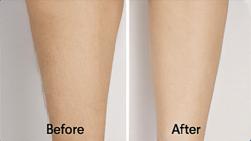 KDT FrostMax Diode Laser Hair Removal Machine in Surrey BC, Canada