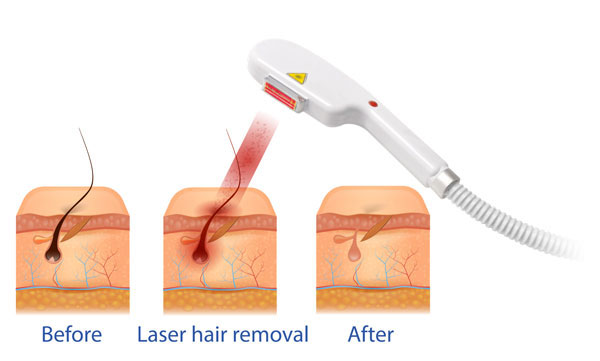 KDT 750, IPL Laser Hair Removal machine in Toronto