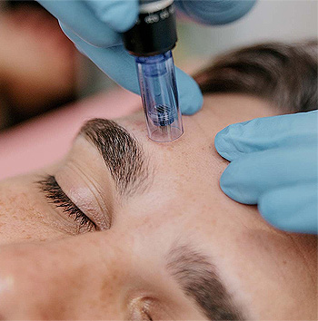 Kaloya Microneedling Pen in Surrey BC, Canada