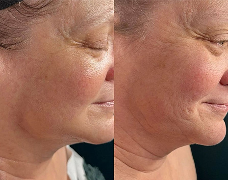 Kaloya Microneedling Pen in Surrey BC, Canada
