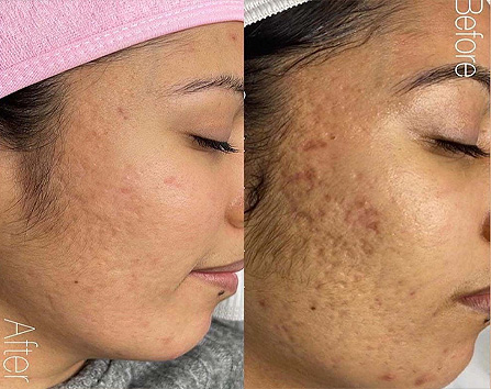 Kaloya Microneedling Pen in Surrey BC, Canada