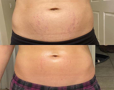 Kaloya Microneedling Pen in Surrey BC, Canada