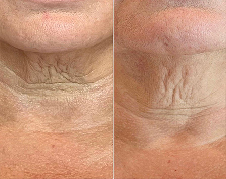 Kaloya Microneedling Pen in Surrey BC, Canada