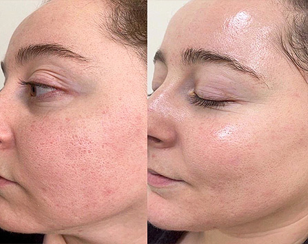 Kaloya Microneedling Pen in Surrey BC, Canada