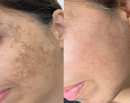 Kaloya Microneedling Pen in Surrey BC, Canada